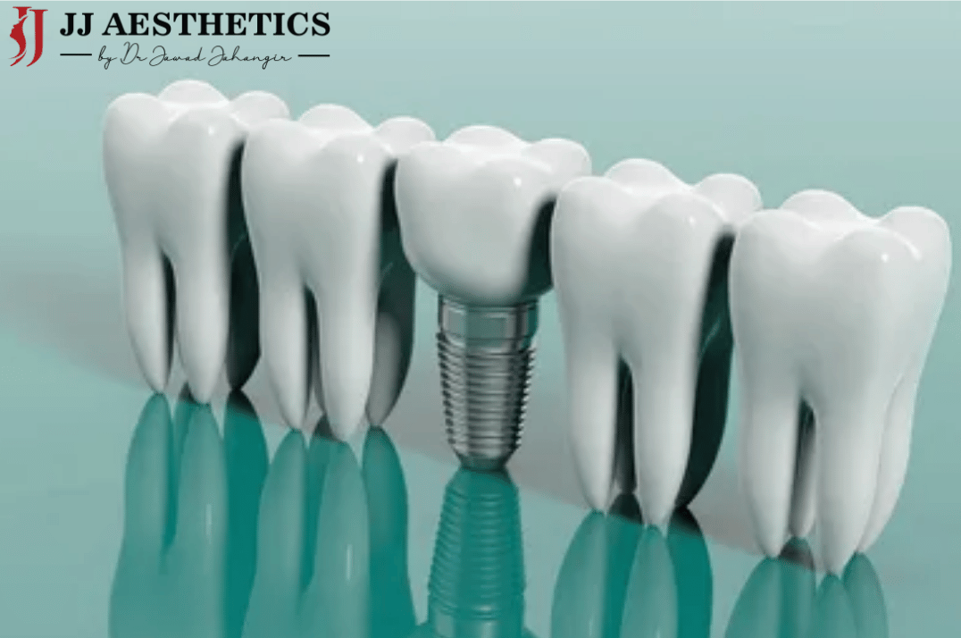 Dental implant in Islamabad Pakistan